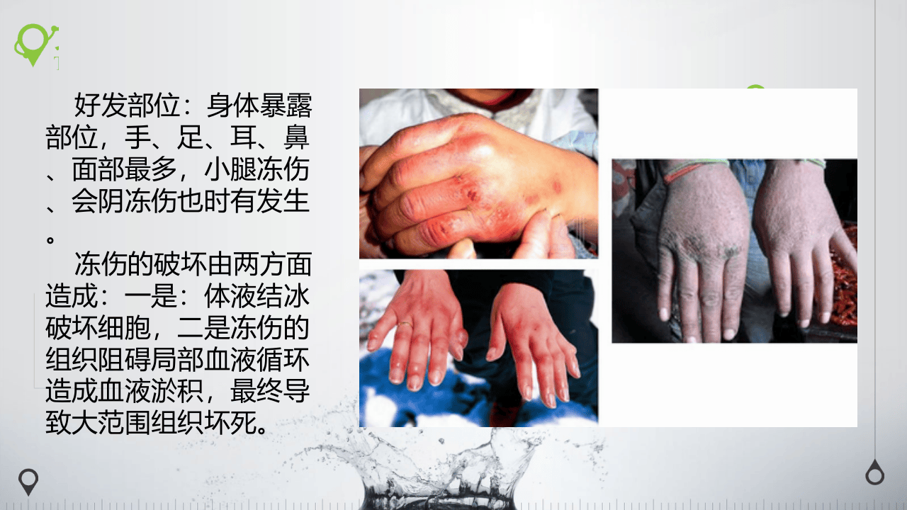 低温冻伤.pptx 第4页